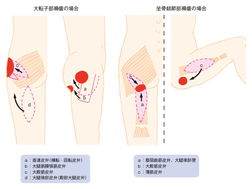 褥瘡好発部位の皮弁採取部