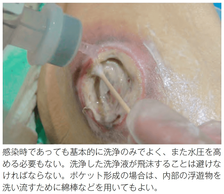 感染・炎症を伴う褥瘡洗浄方法