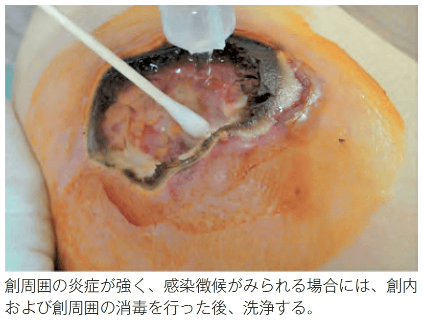 創部の消毒