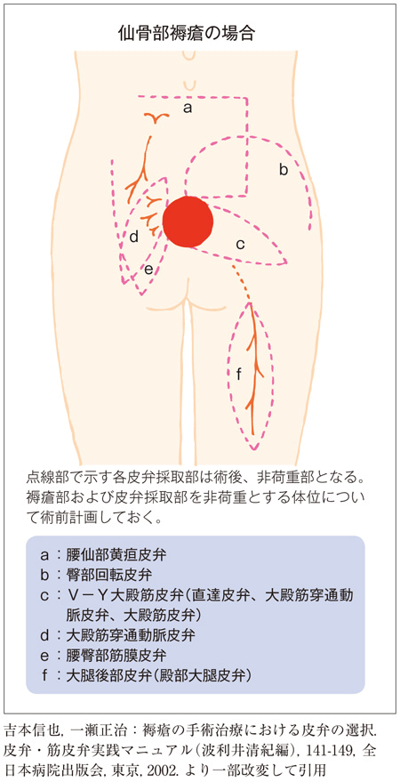 褥瘡好発部位の皮弁採取部