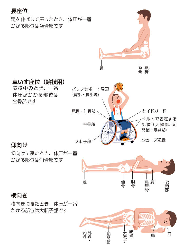 図4 褥瘡のできやすい部位