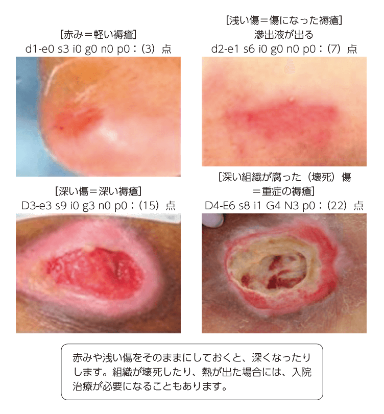 図6 褥瘡の分類